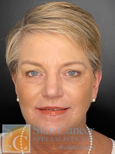 Filler around mouth and lips-after