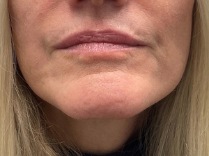 Juvederm b4 & after-before