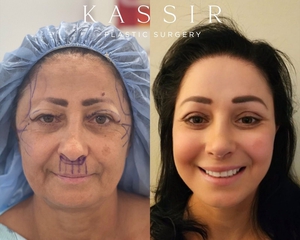 Before & After Designer Face and Neck Lift by Dr. Kassir-before