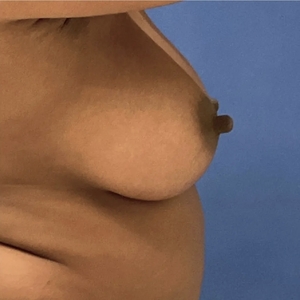 Breast Augmentation #3 400 cc-after