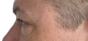 Dry, dehydrated skin-after