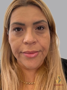 Cellenis Derma 11 ML kit, tear troughs and Cheeks-before