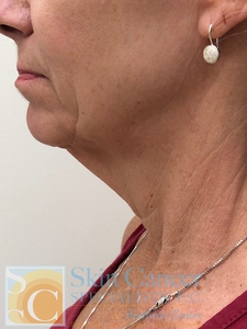Jaw line filler-before