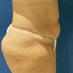 Tummy Tuck #5-before