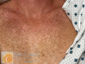 After 1 treatment-before