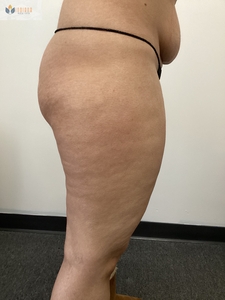 Cellulite reduction-after