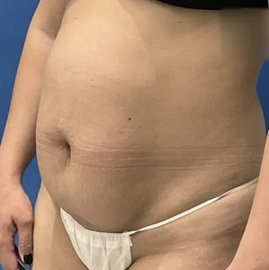 Lipo w Renuvion #5-before