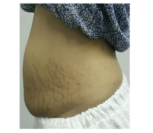 Body Contouring-after