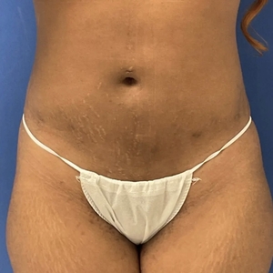 Lipo w Renuvion #10-after