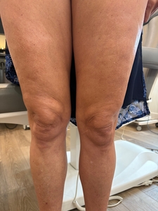 1 Syringe of Radiesse and 1 Sofwave Treatment-after