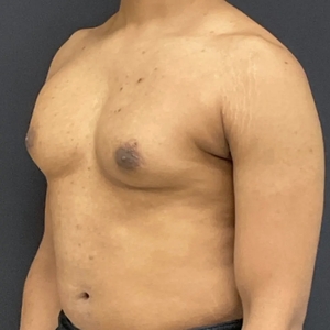 Lipo w BodyTite #9-before