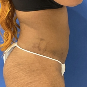 Lipo w Renuvion #10-after