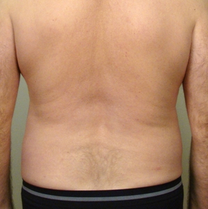 Liposuction #3-before