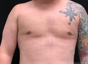 5'9 195lb 1 month post op BodyTite chest-after