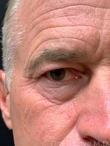 With periorbital Morpheus/Fractora-before