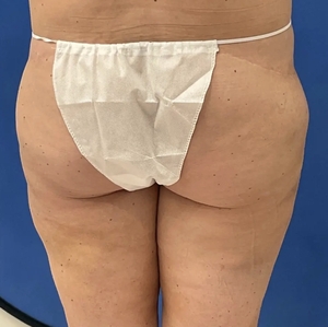 Lipo w Renuvion #1-after