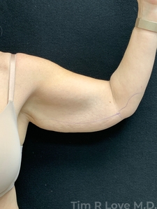 Brachioplasty-before
