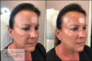 Radiesse Cheeks-before