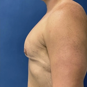 Male Breast Reduction #7-after