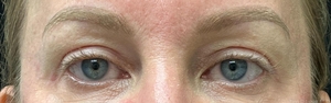 1 month post op upper blepharoplasty-after