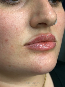 Whitney Devall RN. Versa-after