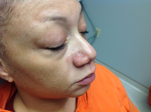 2 Profractional treatments for scar on nose-before