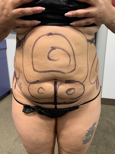 LAL 360 + mini tummy tuck-after