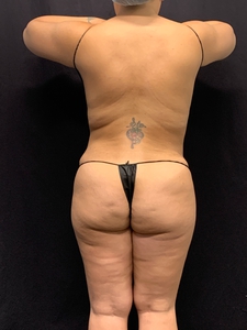 BBL + BBR lipo-before