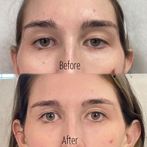 Filler B/A SBA 31-before