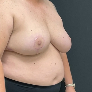 Breast Reduction #2 (right oblique)-after