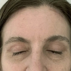 Brow & Eye Lift #3-after