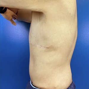 Male Breast Reduction #6-after