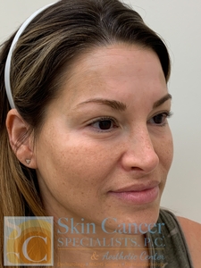 Cheek Filler and Nova Threads Brows-before