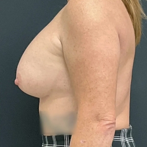 Breast Augmentation #17 455 cc-after