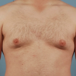Male Breast Reduction #12 (front)-before