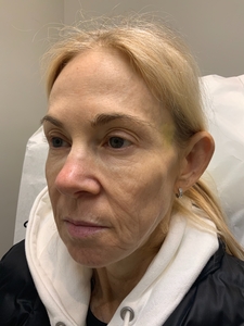 Treatment for wrinkles, pore size, hyperpigmentation, skin tightening-before