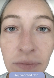 Uneven skin tone, dehydrated skin-after