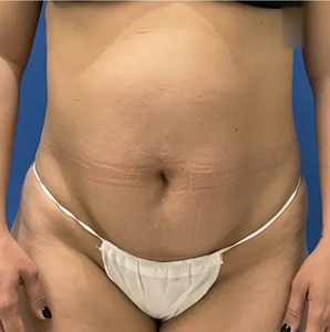 Lipo w Renuvion #5-before