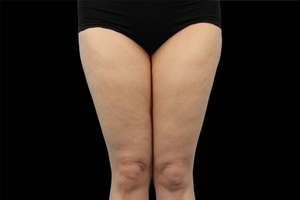4 Treatments-after