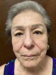 1 month after 3rd Secret RF treatment-after