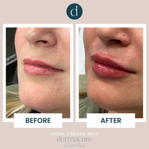 Lip Filler - Trisha O'Meara, NP-C-before