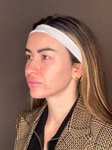 Demeri Cobb- Facial Balancing-before