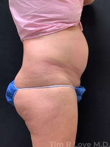 Abdominoplasty - Traditional-before