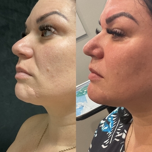 RF Microneedling - Chin Scar-before