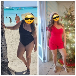 Medical Assisted Weightloss-before