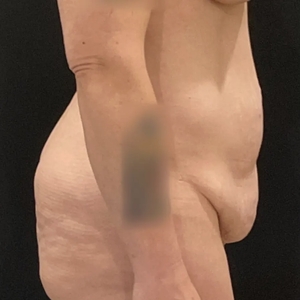 Mommy Makeover #13-before