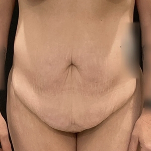 Mommy Makeover #13-before