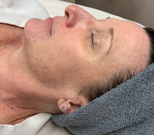 IPL photo facial-after