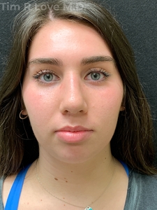 3 Months Post Op-after