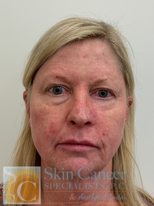 Nova Threads-neck, cheeks and around mouth-after